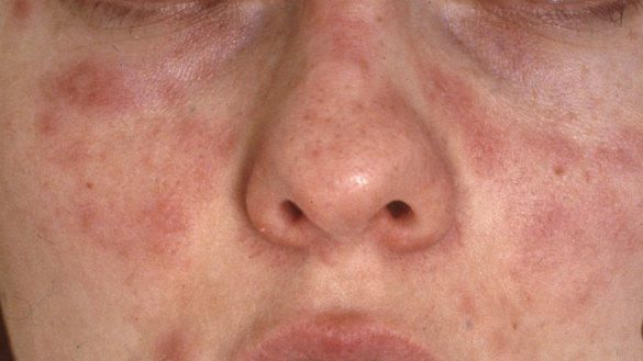 Aurinkoihottuma ja valoherkkyys