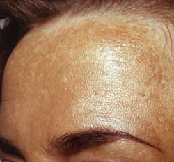 Melasma (hyperpigmentaatio)