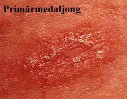 Punatäplähilseily (Pityriasis rosea)