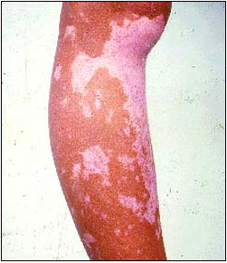 Vitiligo (valkopälvi)