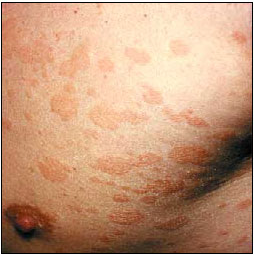 Savipuoli (Pityriasis versicolor)