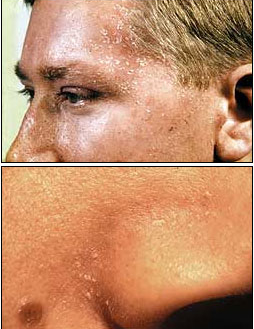 Seborrooinen ekseema eli tali-ihottuma