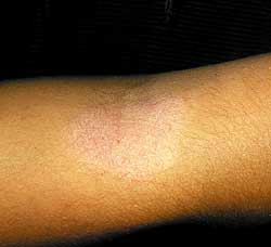 Valkohilse (Pityriasis alba)