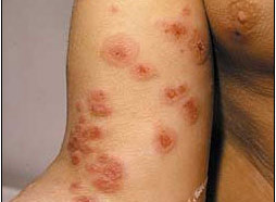 Monimuotoinen punavihoittuma (Erythema multiforme)