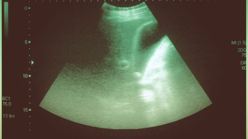 Sappikivet voidaan helposti paikantaa ultraäänitutkimuksella.