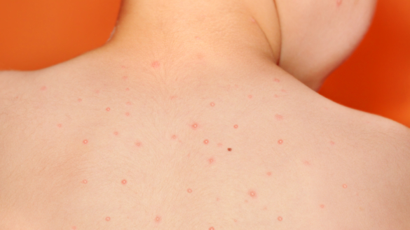 Vihurirokko (rubella)