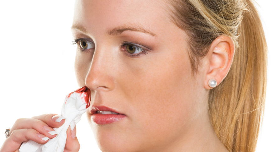Nenäverenvuoto johtuu yleensä siitä, että nenän väliseinän pinnalliset verisuonet rikkoutuvat.