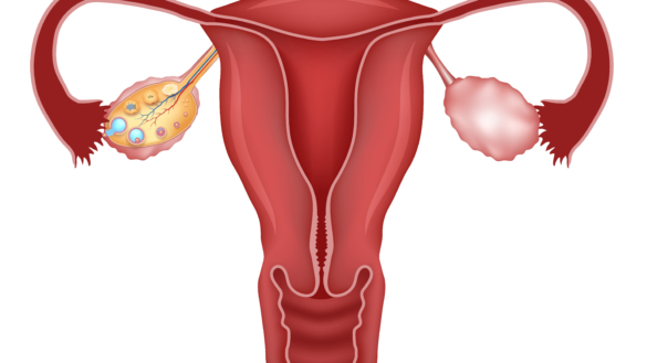 Munasarjojen monirakkulaoireyhtymä (polycystic ovary syndrome, PCOS)