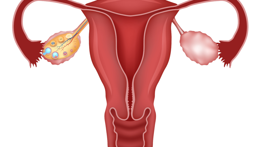 Munasarjojen monirakkulaoireyhtymässä munasarjoissa on nestetäytteisiä rakkuloita, ja oireyhtymä voi aiheuttaa muun muassa hedelmättömyyttä.