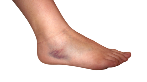 Nyrjähdyksiä ja mustelmia (hematooma)