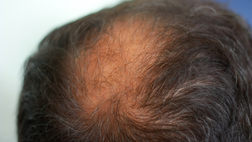 Miestyyppinen hiustenlähtö (androgeeninen alopecia)