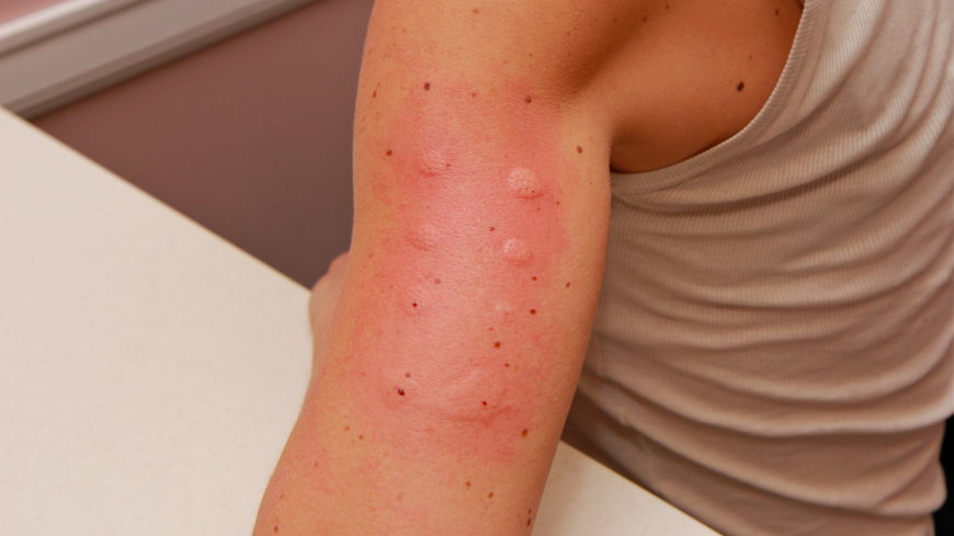Iholle tehtävillä pistokokeilla voidaan kartoittaa allergeenejä, jotka aiheuttavat anafylaktisen reaktion.